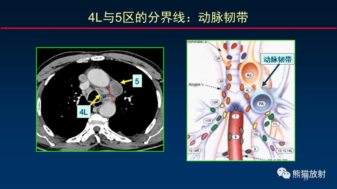 最新颈部淋巴结分区,“颈部淋巴结最新分区图解”